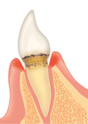 歯周病の進行度