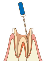 根管治療の流れ