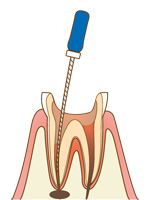 根管治療の流れ