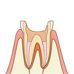 根管治療の流れ