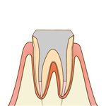 根管治療の流れ